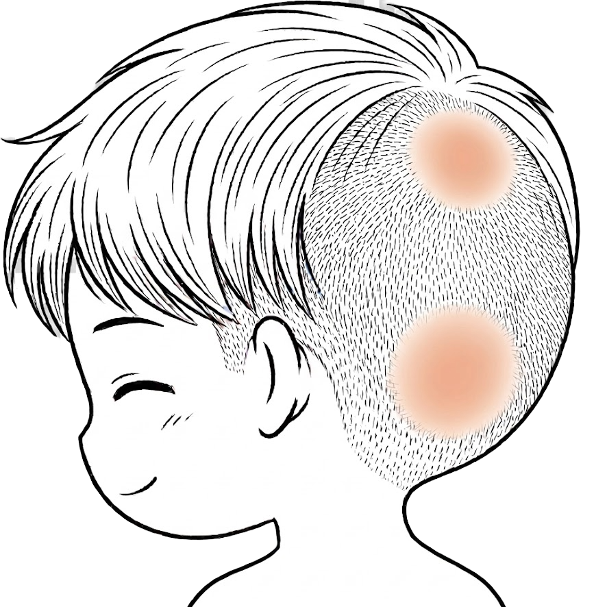 圓形掉髮