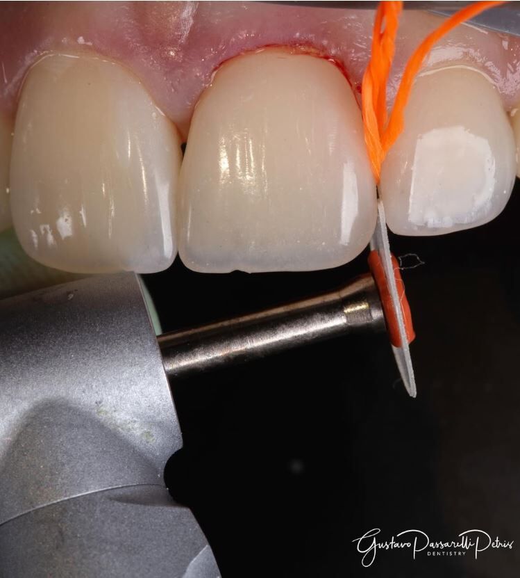 口內半透明拋光磨光片