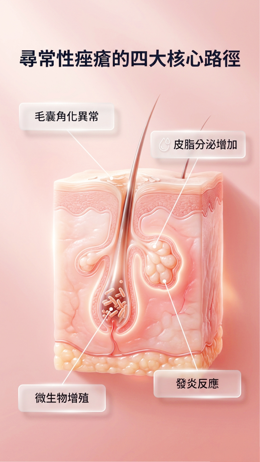 尋常性痤瘡的四大核心路徑