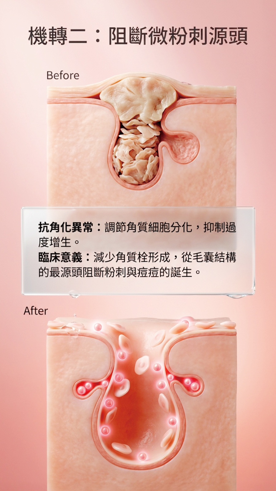 機轉 2 : 阻斷為粉刺源頭