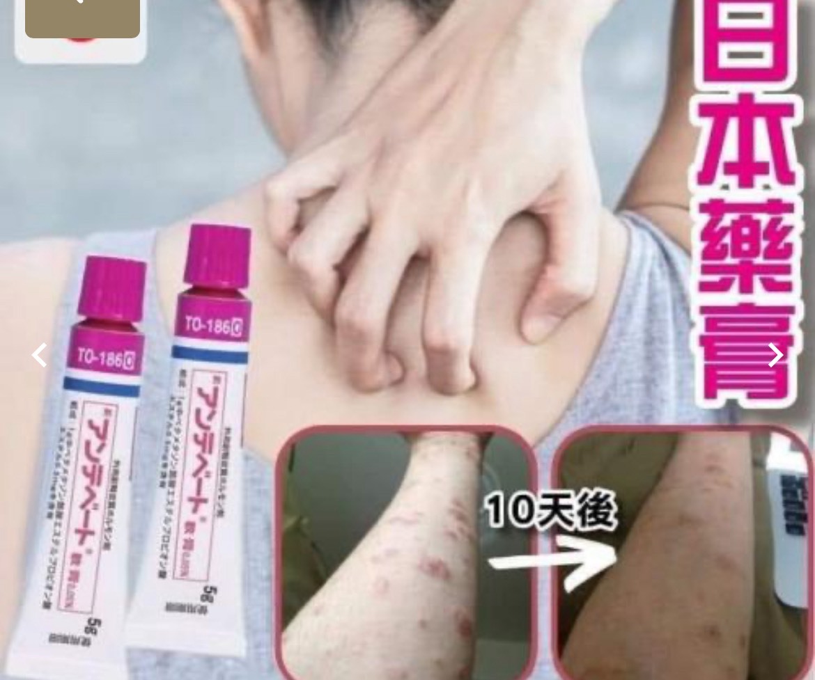 鳥居製藥｜蕁麻疹特效塗抹膏 5g