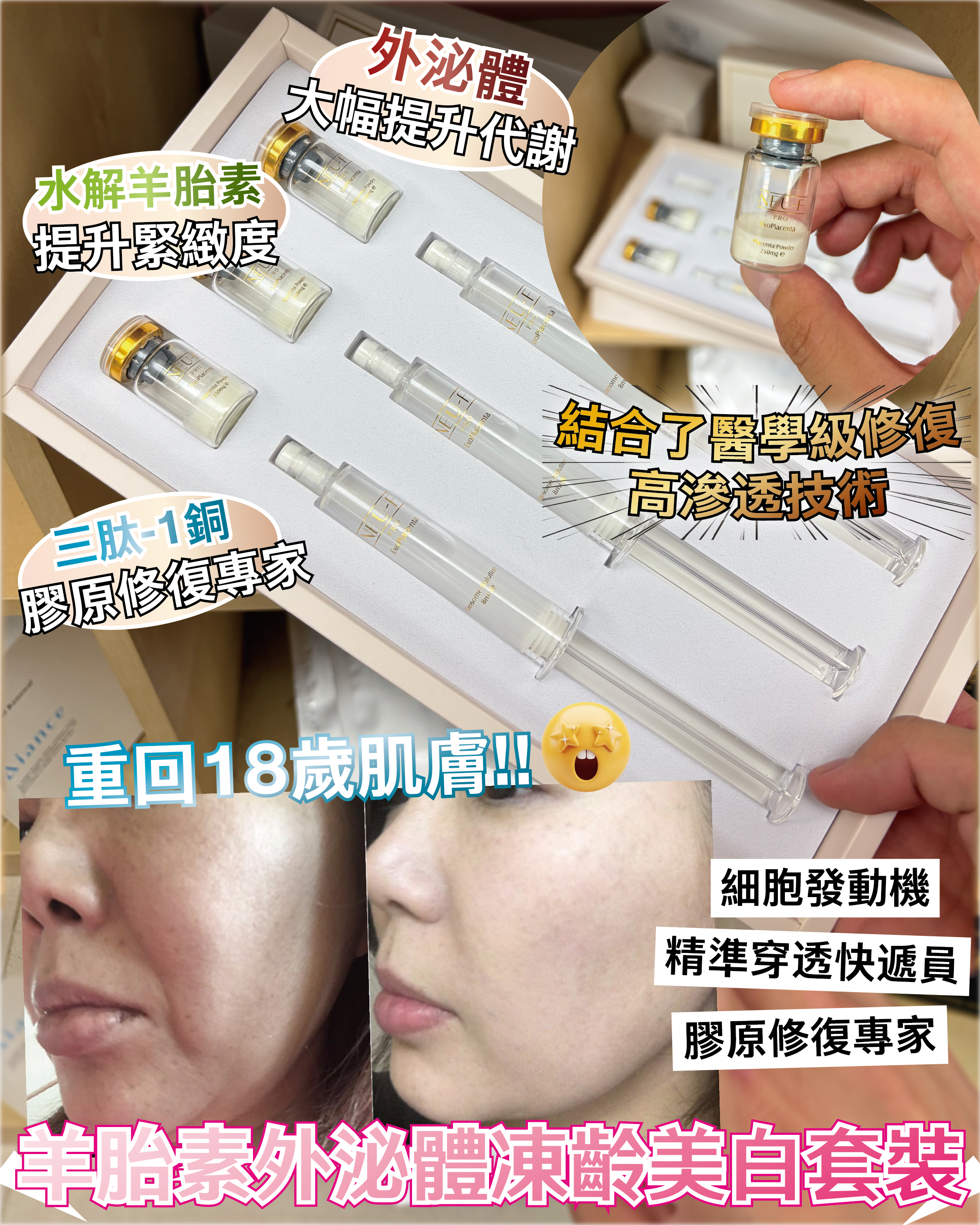 🇫🇷 法國護膚美學直擊 - Neu-F Pro 羊胎素活顏抗皺修護乳霜 + Revitalizing Placenta Powder + Exosome Solution 外泌體凍齡美白套裝 送 Revitalizing Toner 羊胎素活顏抗皺修護精華水 x 1 + Acnecea Exosome Dry Mask x 1（貨期兩個月）