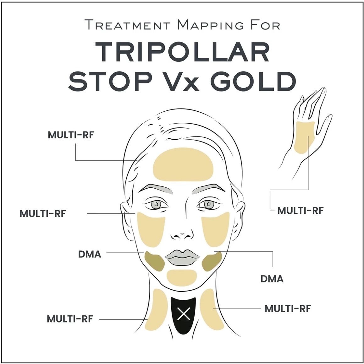 [香港行貨] Tripollar金礦 STOP VX2 GOLD RF射頻時光機 提拉緊緻美容儀(2 年保養 )
