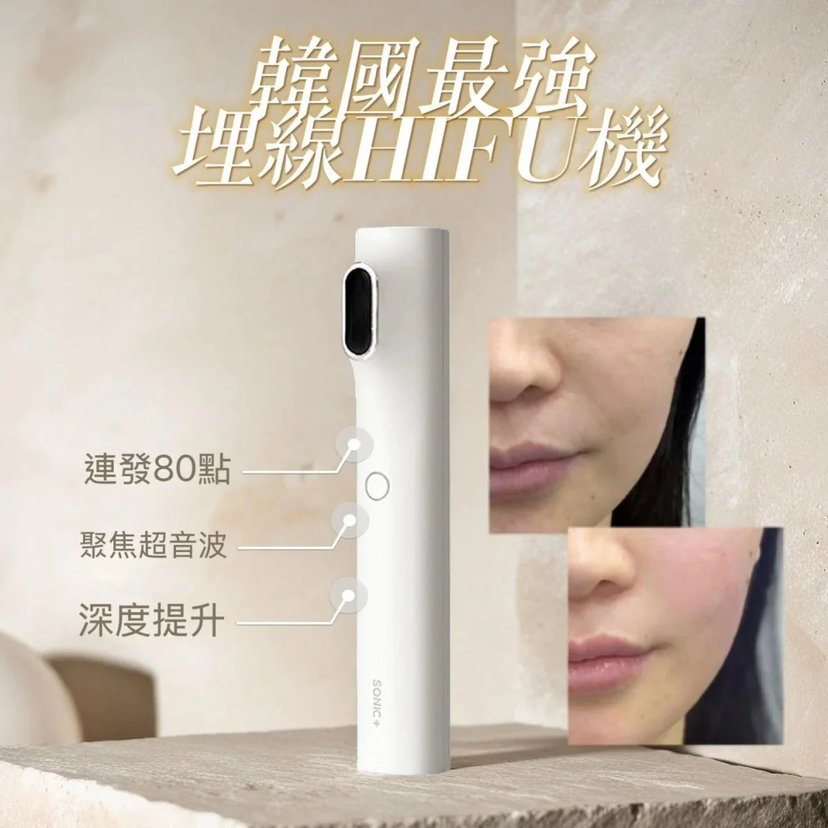 韓國製Innocera Sonic+ 80 HIFU機 (升級10萬發數) 送導入凝膠