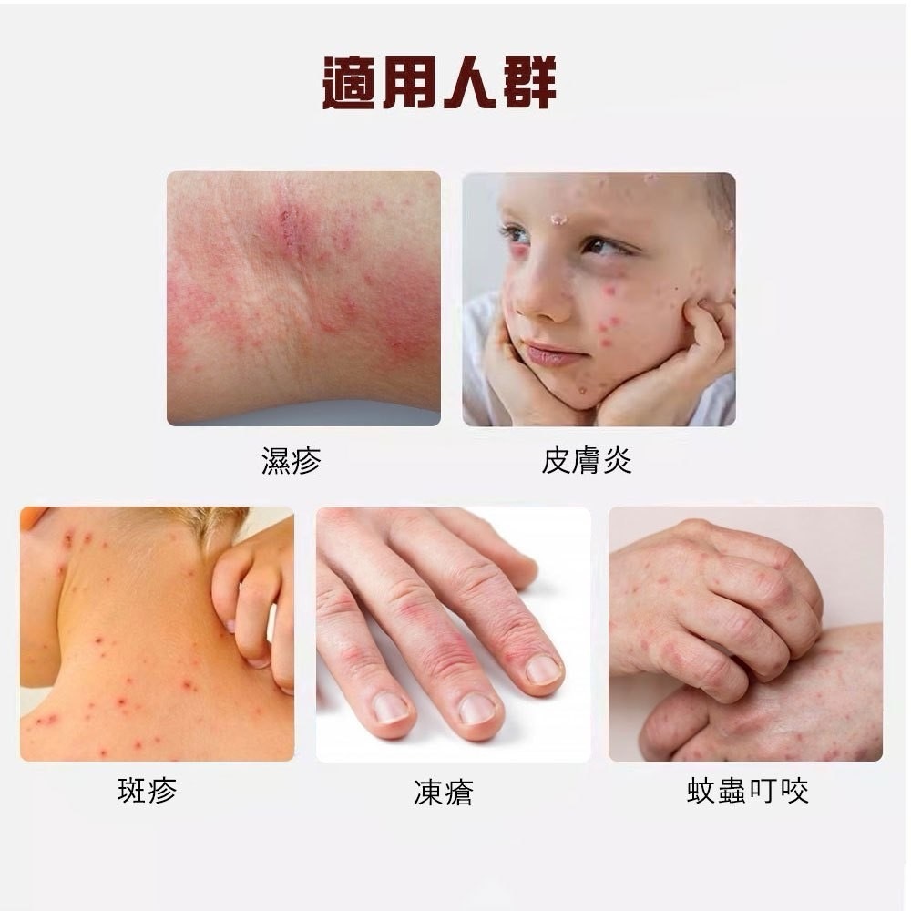 【日本田邊三菱】Flucorte F濕疹藥膏5g
