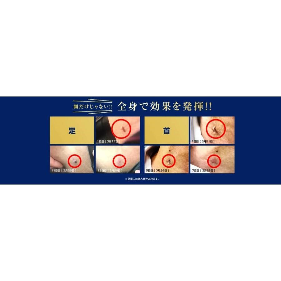 Ipocare EX 除疣專用美容凝膠25g