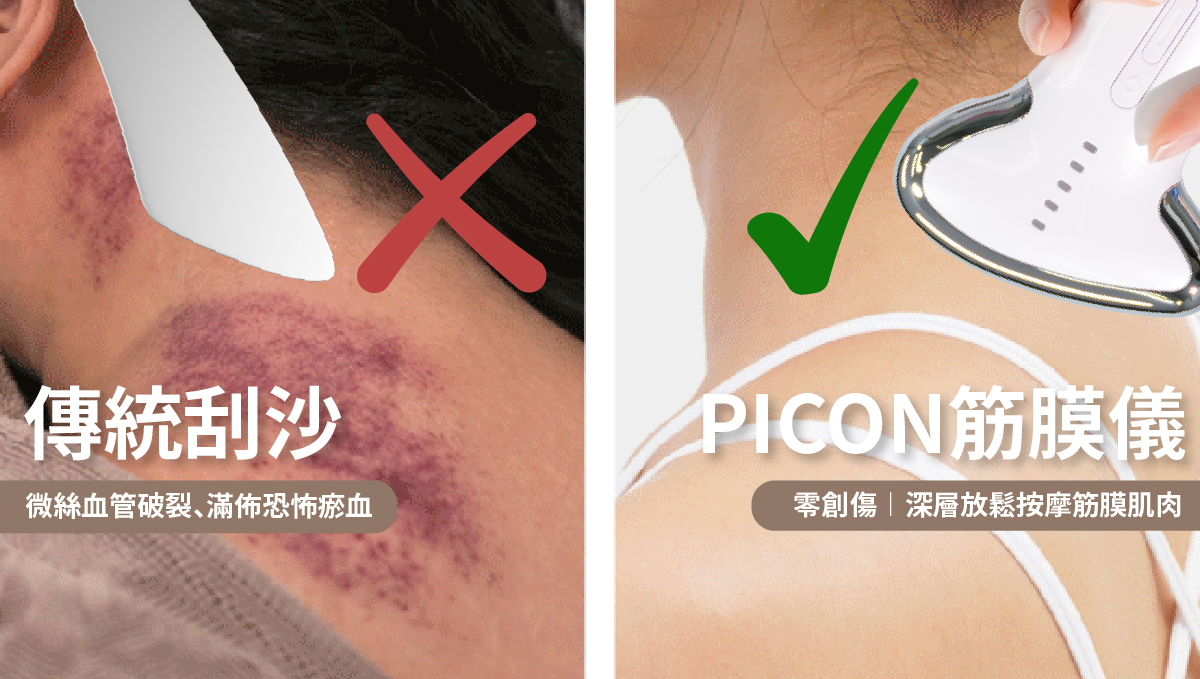 傳統刮痧瘀血 vs PICON 無痛微電流深層筋膜放鬆對比