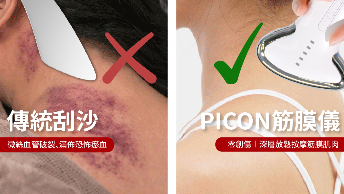 PICON 溫和無痛筋膜放鬆，對比傳統刮痧造成的恐怖瘀血傷害