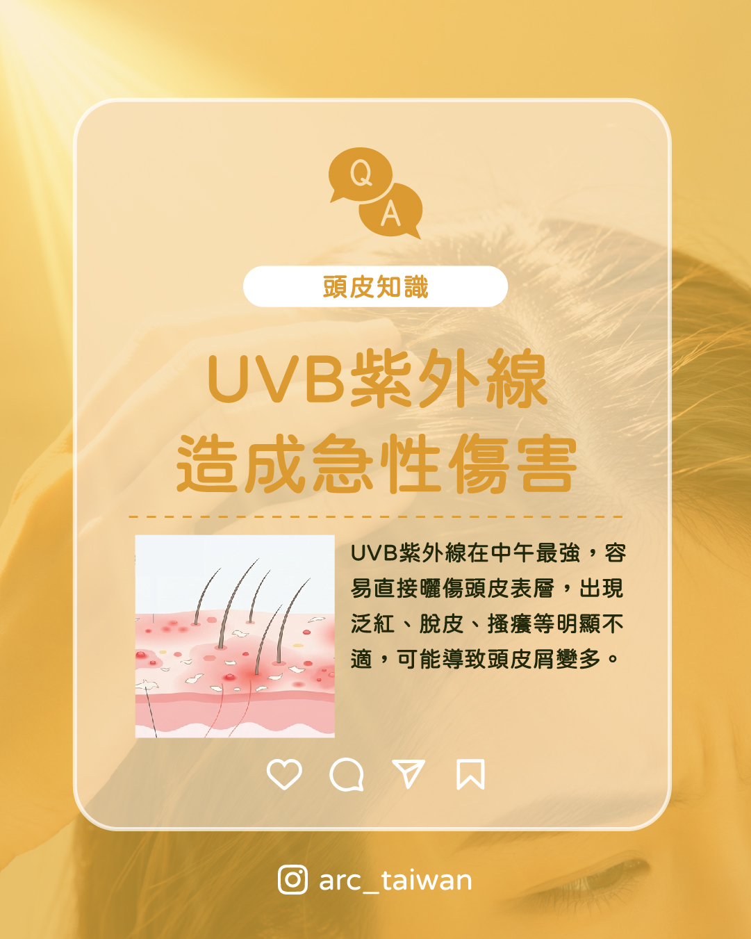 UVB|傷在表面,立即有感 直接灼傷頭皮表層, 出現泛紅、脫皮、搔癢等明顯不適。 簡單說: UVA 是慢性傷害,UVB 是急性刺激, 兩個加在一起,就是夏天頭皮變敏感、掉髮變多的主因。