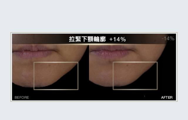 HR黑繃帶線雕輪廓精華