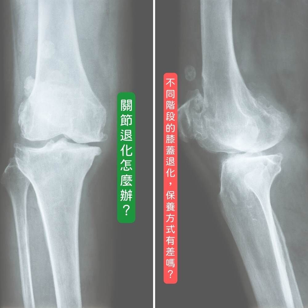 不同階段膝蓋退化保養方式示意圖