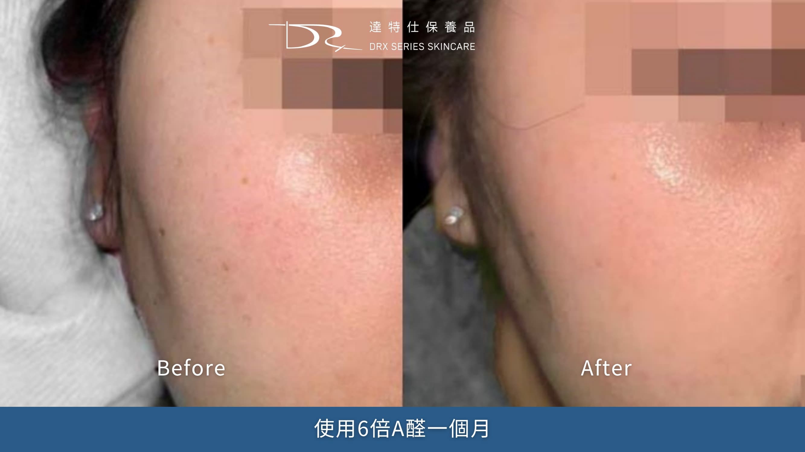 DRX 6倍全效淨白A醛煥膚的成分是A醛。大部分研究報告(註一)支持 A醛的幾個主要用途：抗老、淡化細紋、膚質粗糙、毛孔、亮白與皮膚保濕，這些研究多是針對 0.05%–0.1%的A醛， DRX 0.3%濃度在A醛中屬於較高的。
