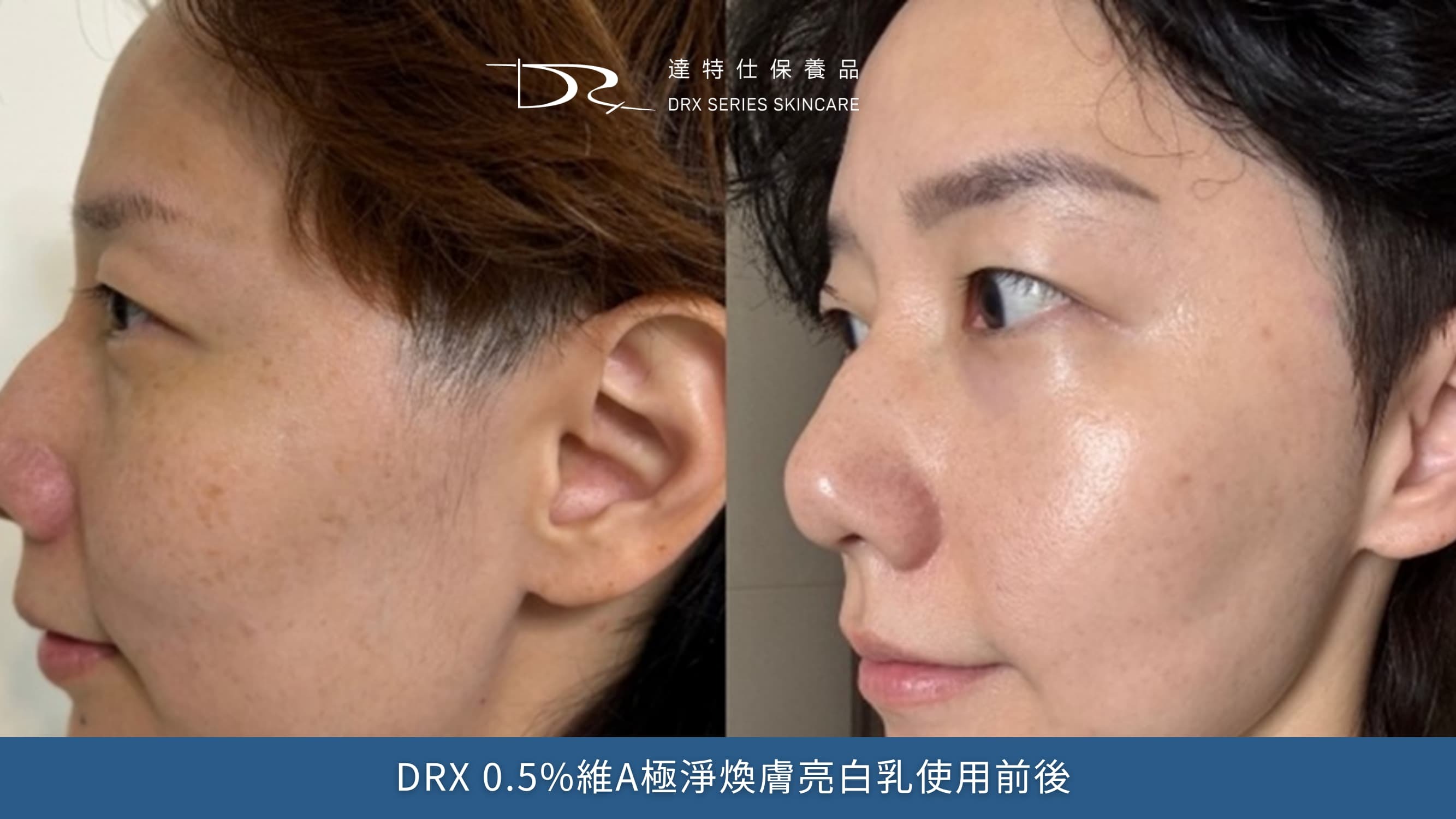單靠一罐DRX 6倍全效淨白A醛煥膚，真的會變白、變亮，但這種變白程度可能大多數的人還不會發現到。想要更明顯的白，別忘了DRX 0.5%維A極淨煥膚亮白乳。
