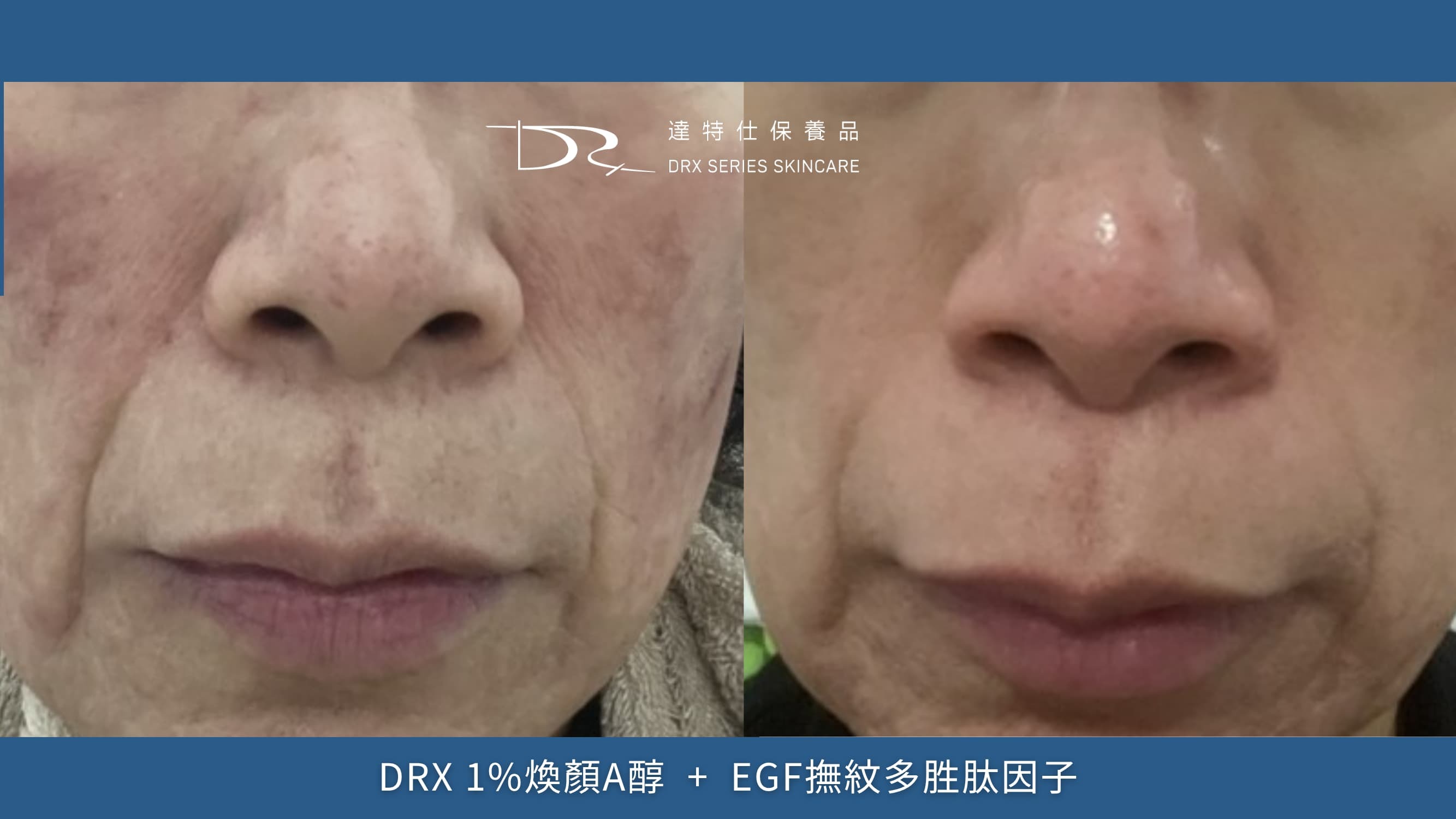 1%濃度耐受度更佳，天天擦也擦得住，既屬於高濃度A醇，又能持久使用，因此對肌膚淡化皺紋的效果更佳。另外，1% A醇也適合當作油性肌膚的入門款使用。