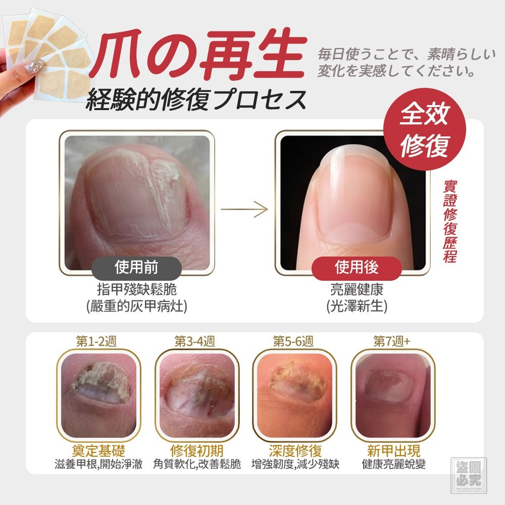 S21915 日式 灰甲保健貼20貼
