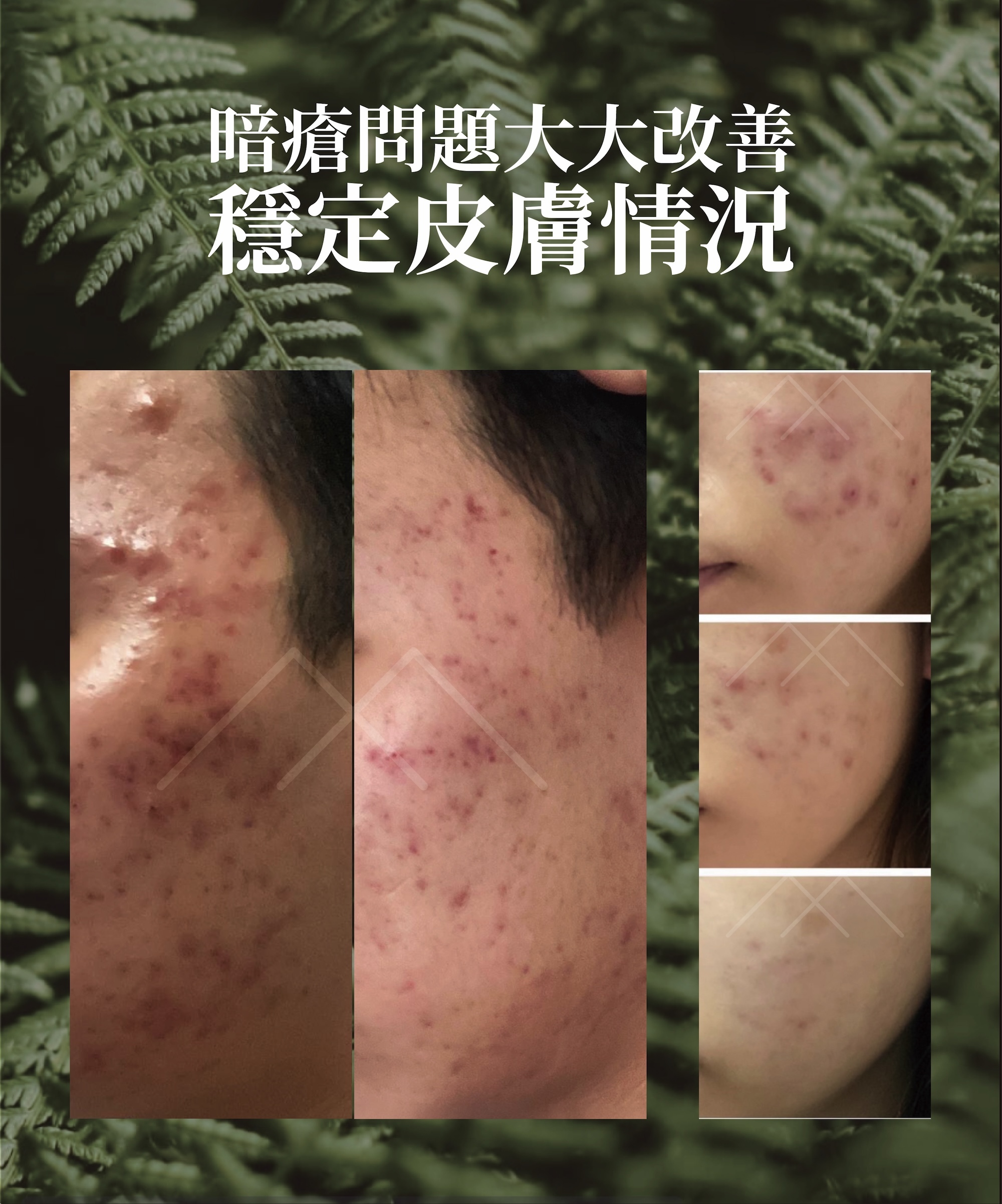 去痘去印套裝（加強版）
