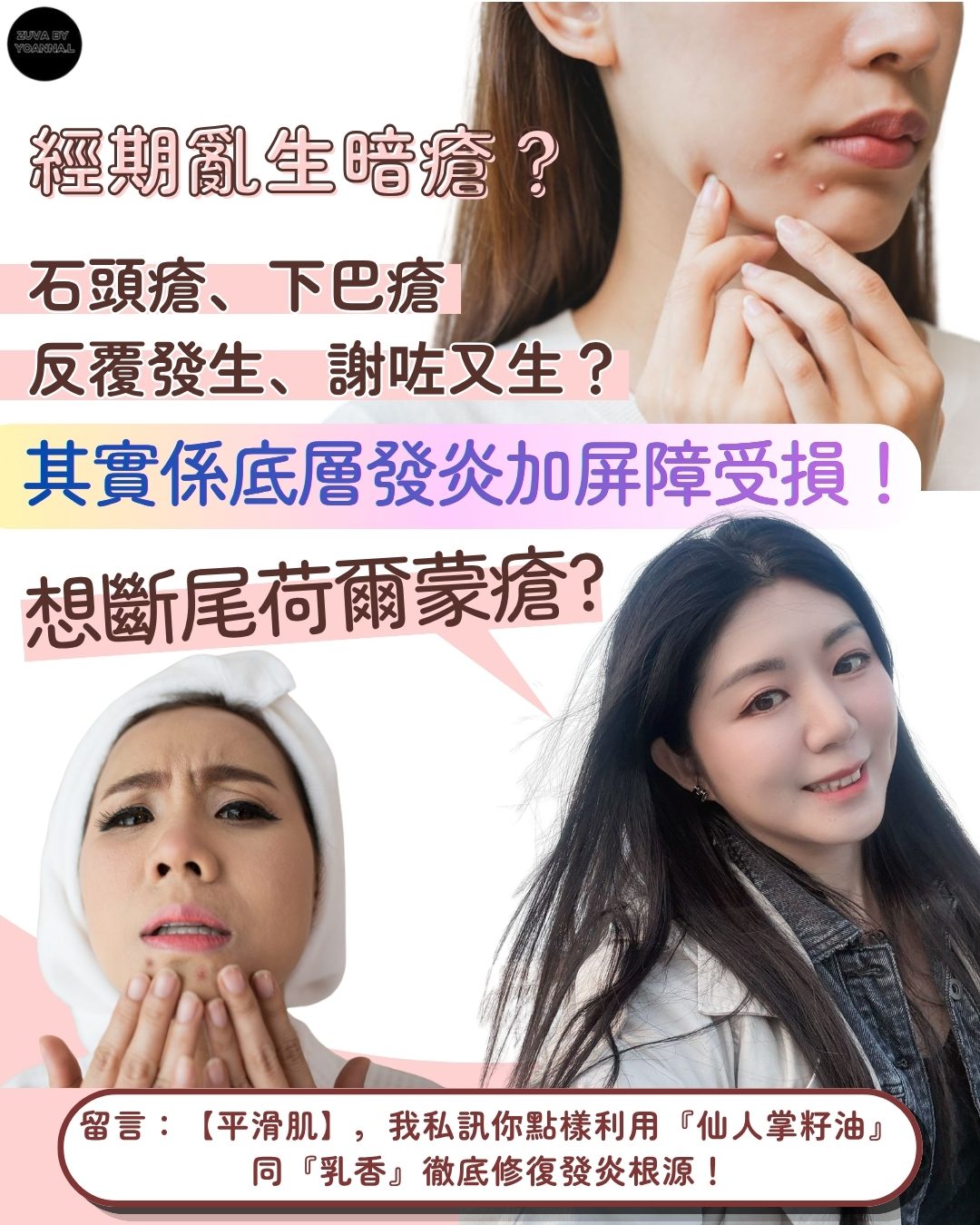 荷爾蒙瘡