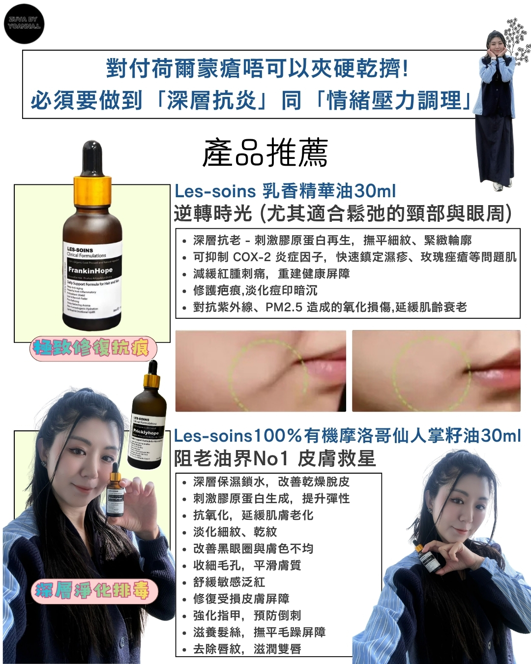 荷爾蒙瘡