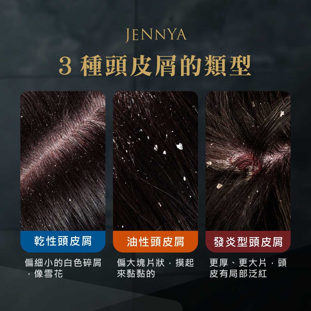 頭皮屑種類,分成乾性頭皮屑、油性頭皮屑、發炎性頭皮屑