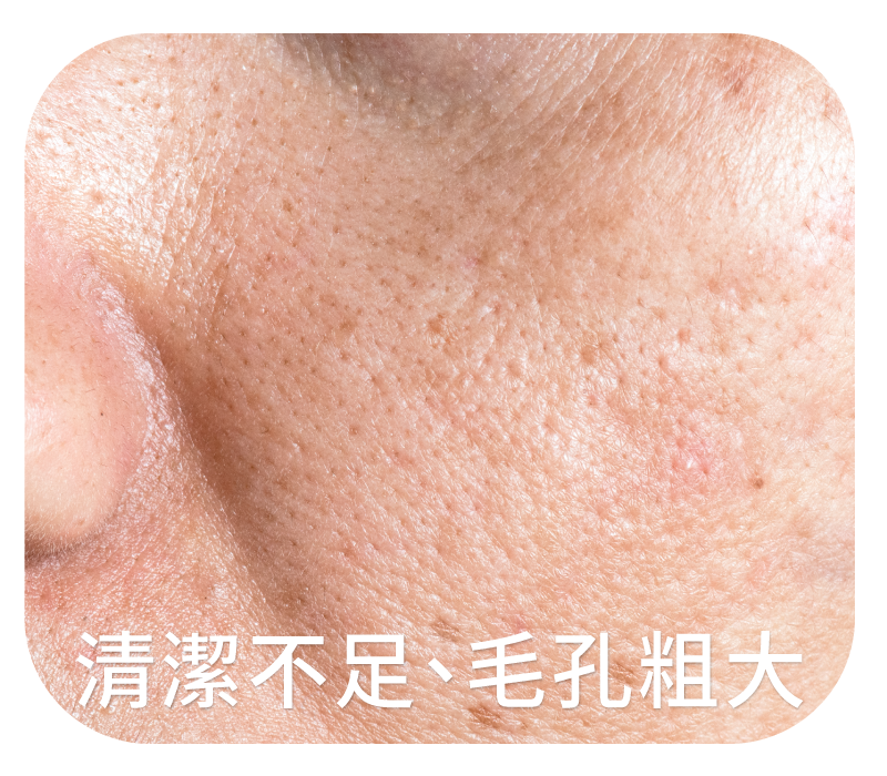 清潔不足、毛孔粗大