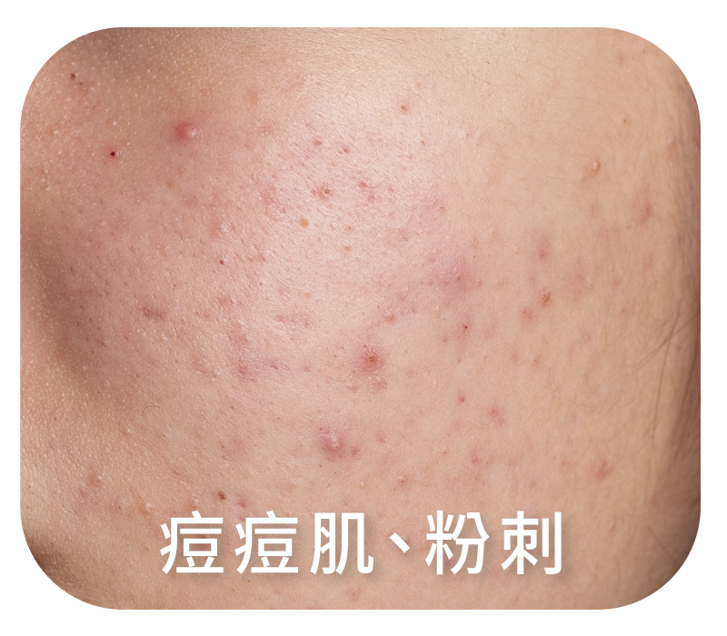 痘痘肌、粉刺