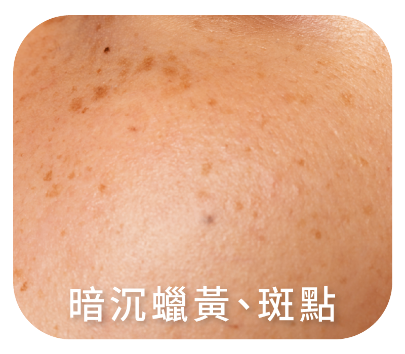 暗沉蠟黃、斑點