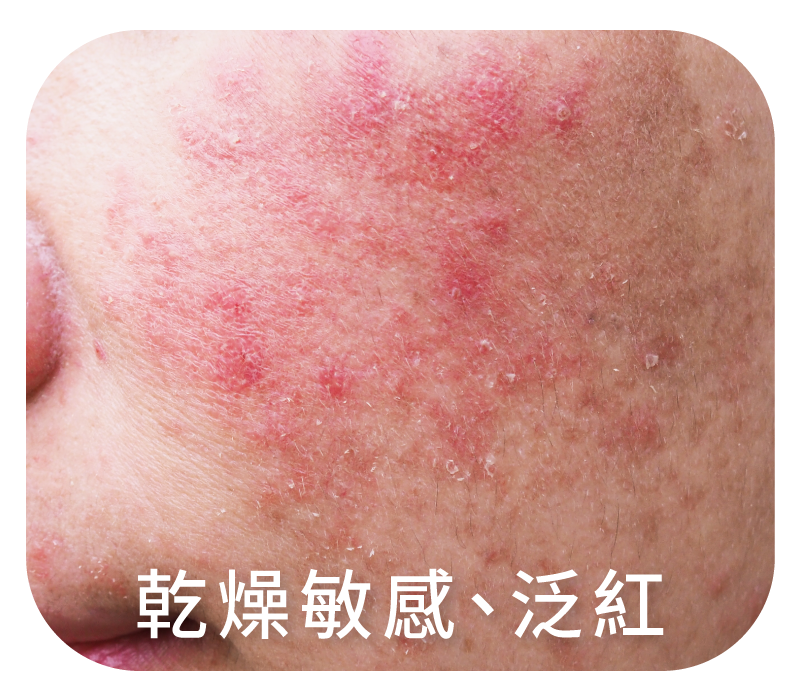 敏感乾燥、泛紅