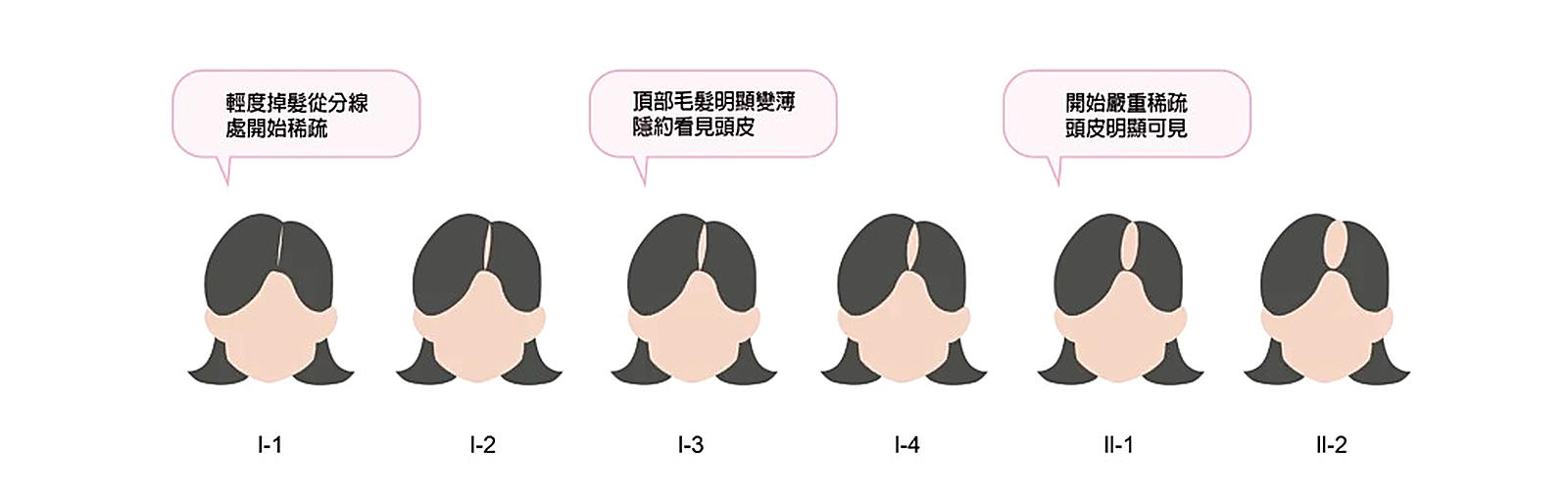 女性落髮範圍 Ludwig-Savin 分類