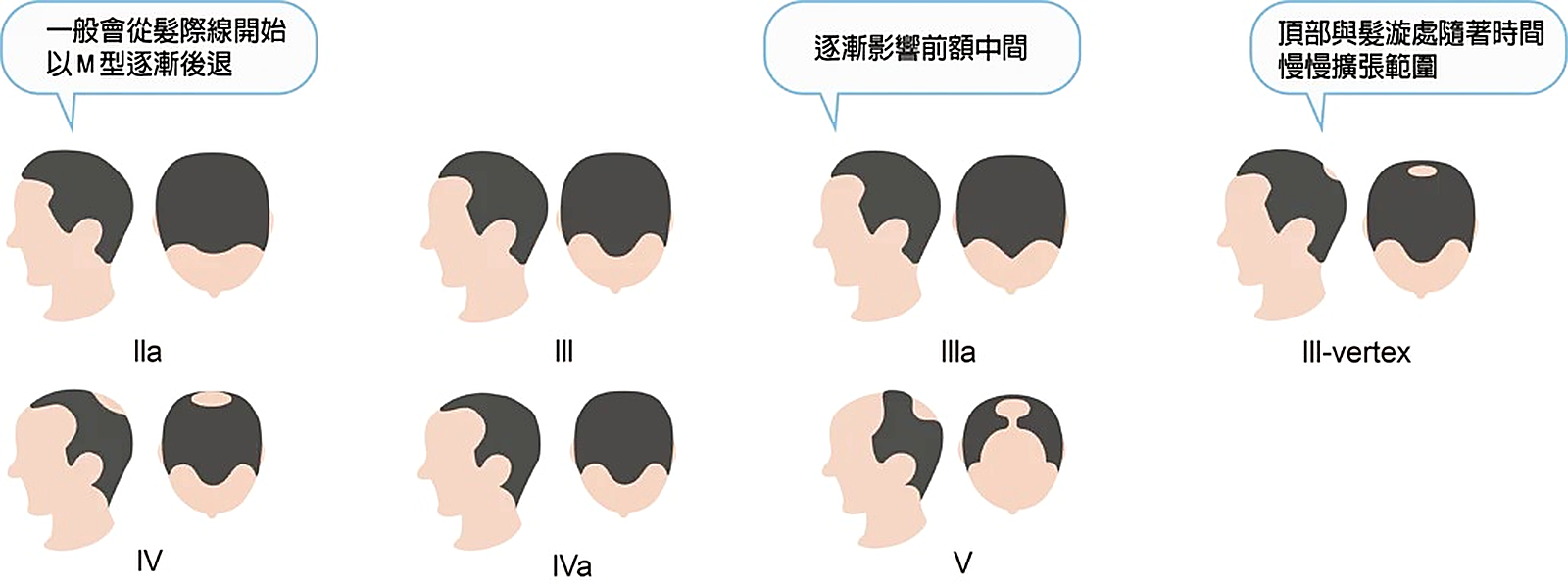 男性落髮範圍 Hamilton Norwood 分類