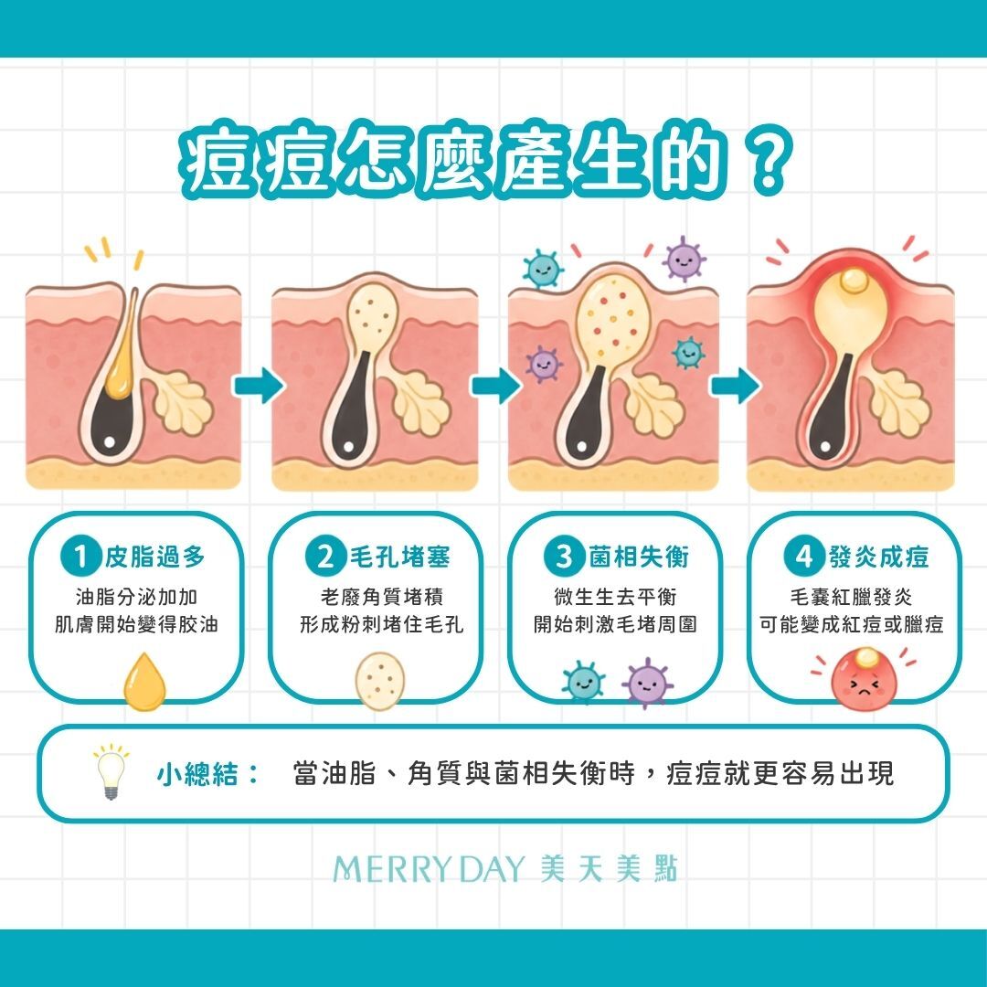 痘痘怎麼產生的?皮脂分泌過多、角質代謝異常、微生物群失衡、發炎反應