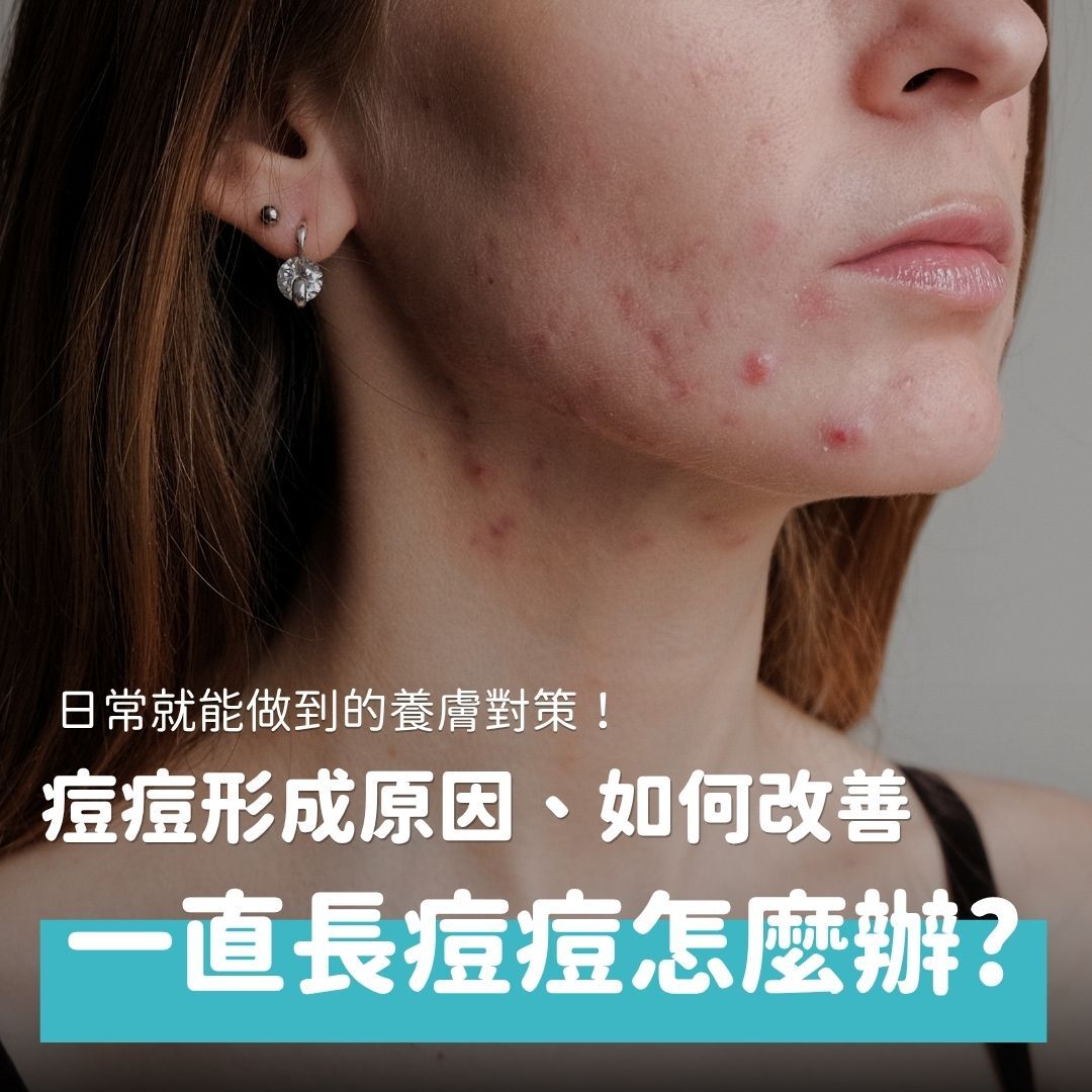 悶熱的夏天來臨，痘痘又開始作亂了嗎？明明清潔保養一樣都沒少，卻還是無法徹底解決。痘痘不只是單純的油脂分泌過多，它和基因遺傳、慢性發炎、荷爾蒙、腸道等等都有關係。本文將介紹這些容易長痘痘的原因，提供日常養膚對策，幫助你重拾乾淨肌膚。
