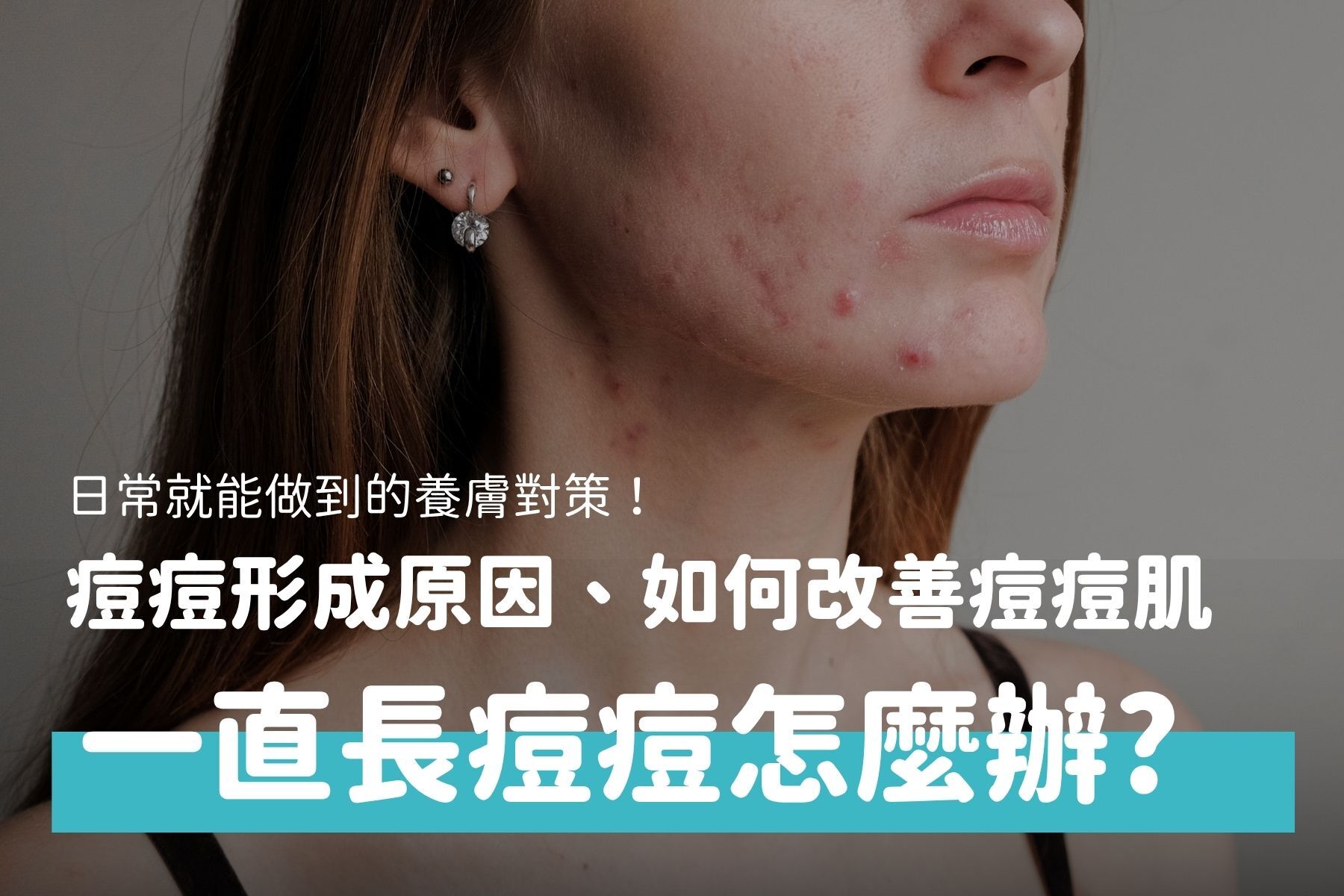 痘痘肌怎麼改善？痘痘形成原因、飲食與日常保養一次看懂