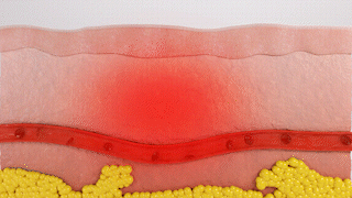 iaso laser penetrating skin