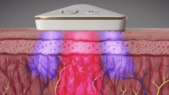 iaso ultra laser penetrating skin
