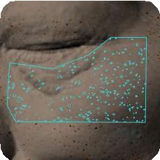 ANTERA 3D 肌膚檢測－突起體積分析範例