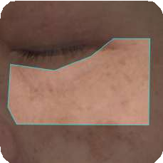 ANTERA 3D 肌膚檢測－毛孔分析範例