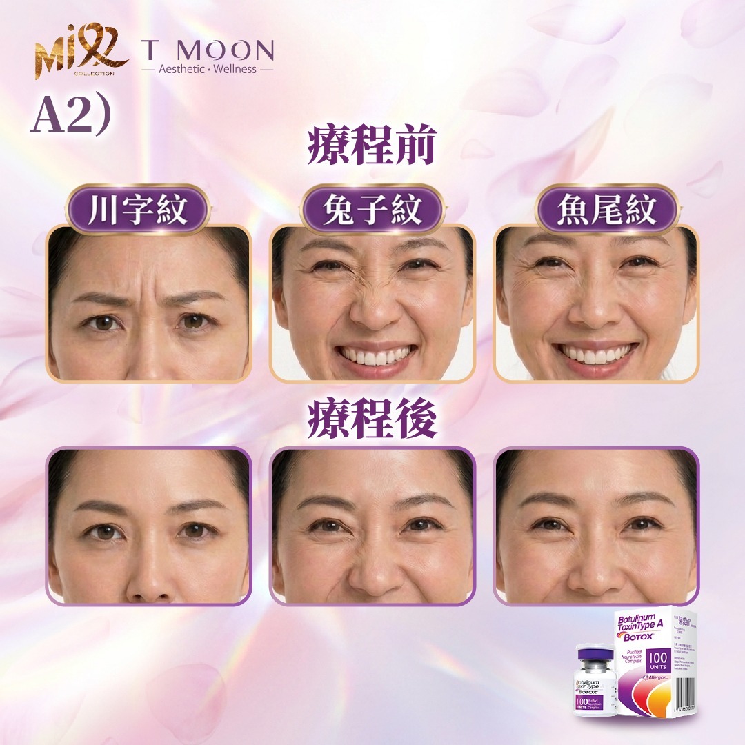 MEB-BBG0731-002 美國正廠Botox肉毒桿菌去皺美顏針【服務到期日:2027年08月13日】 (A2)