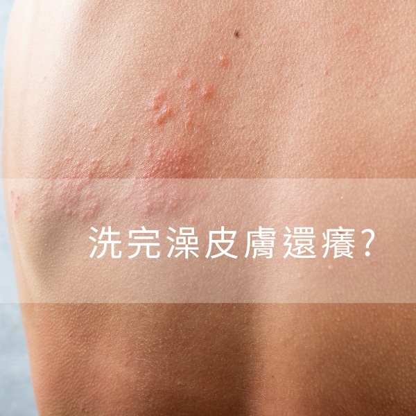 洗澡完皮膚癢還一粒一粒怎麼辦？解密原因、對策及溫和產品推薦