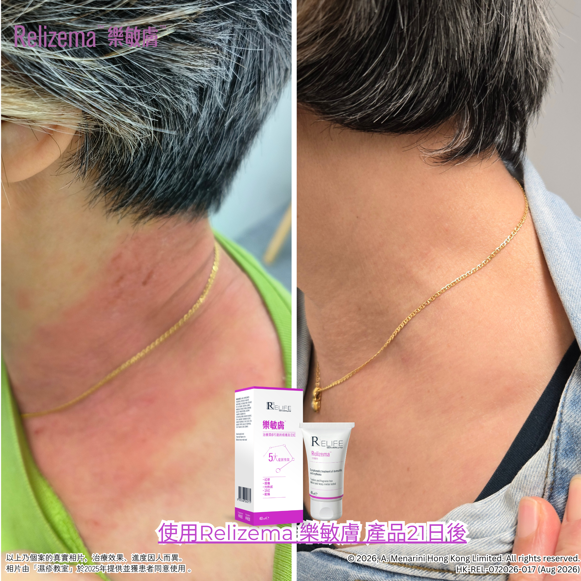 Hero Product] Relizema Cream 40ml