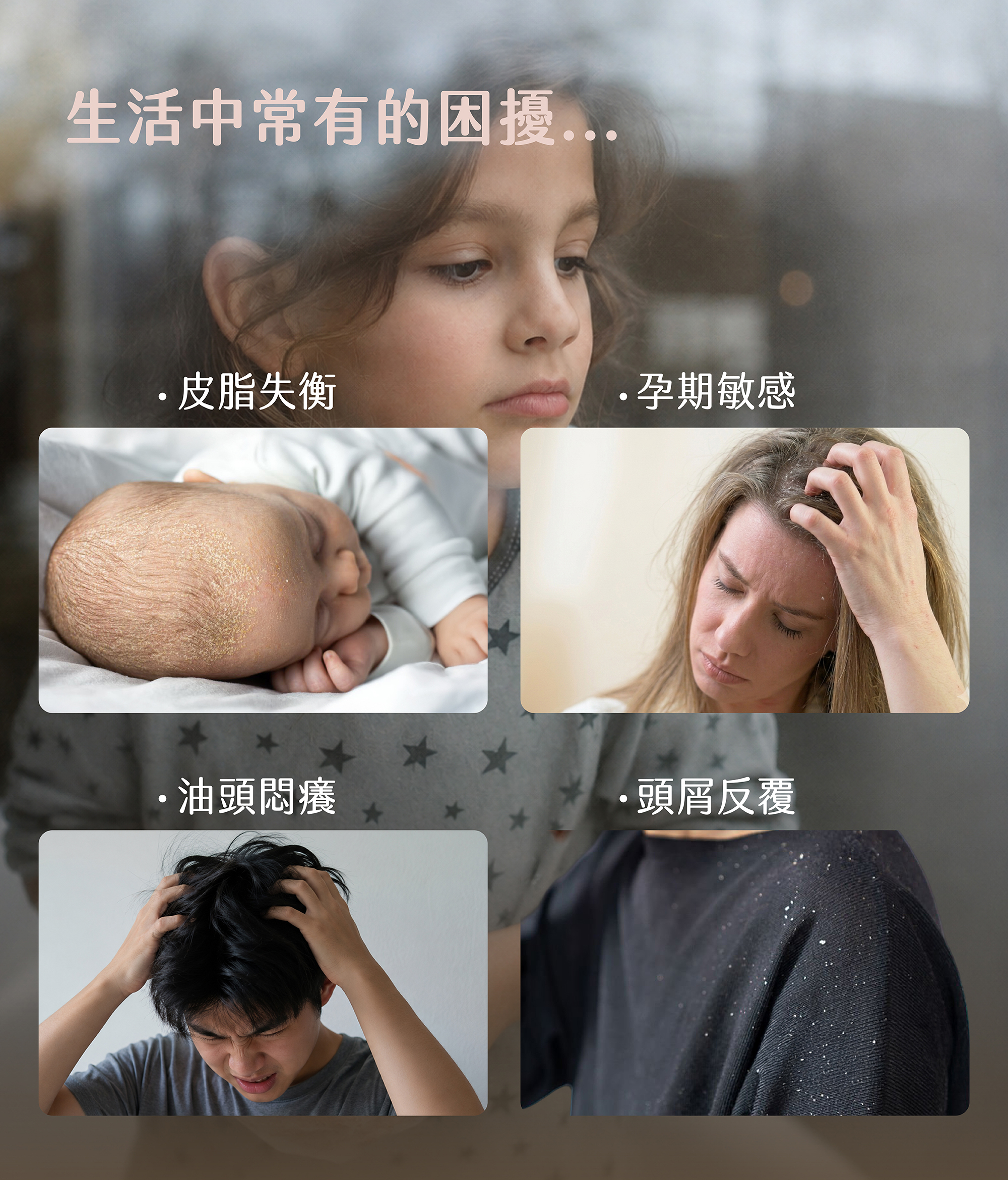 脂漏性頭皮,青春期頭皮發炎,頭上長痘痘,頭皮屑,抓頭,頭很癢