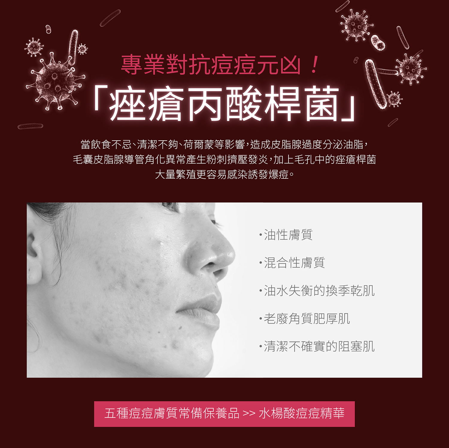 五種痘痘膚質常備保養品 從根源有效打擊痘痘菌群─痤瘡桿菌、預防粉刺爆痘、收斂緊緻毛孔1瓶3效,清爽不悶好吸收!