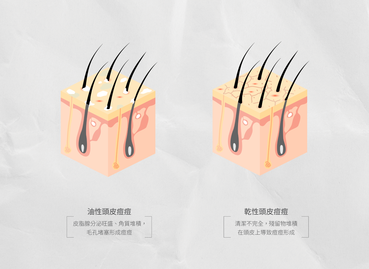 乾性、油性頭皮是什麼?長痘痘原因有哪些