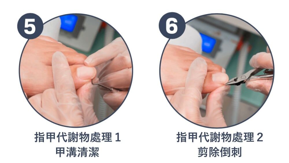 服務流程五：趾甲代謝物處理-甲溝清潔。服務流程六：剪除倒刺