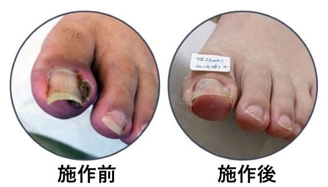 反覆甲溝炎導致產生肉芽，經由阿瘦嵌甲調整後，捲曲的指甲逐漸回到健康的角度
