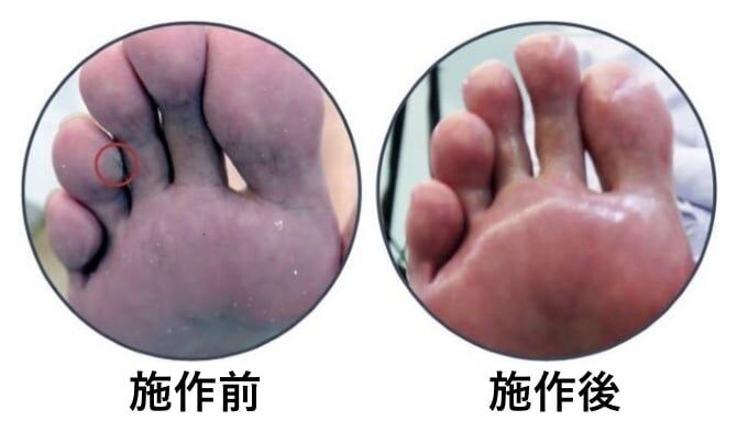 雞眼：健甲師用溫和的方式將雞眼磨除掉