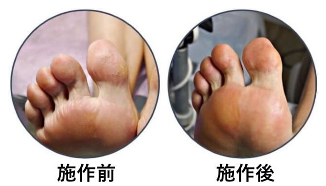 厚繭：健甲師將原本粗糙厚實的繭磨除掉