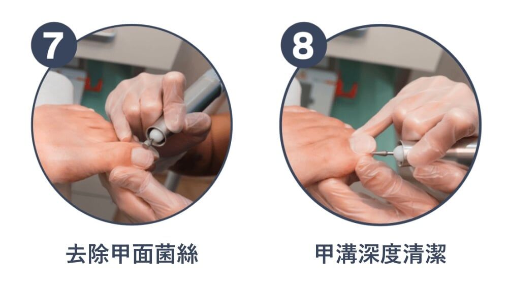 服務流程七：去除甲面菌絲。服務流程八：甲溝深度清潔