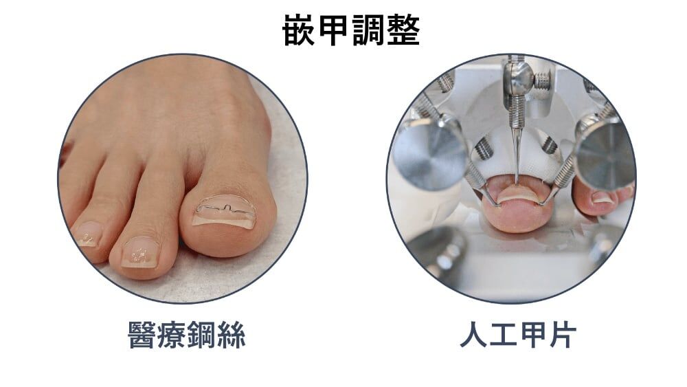 阿瘦獨家嵌甲調整：醫療鋼絲和人工甲片，幫助將卷曲的指甲調整到比較健康的角度