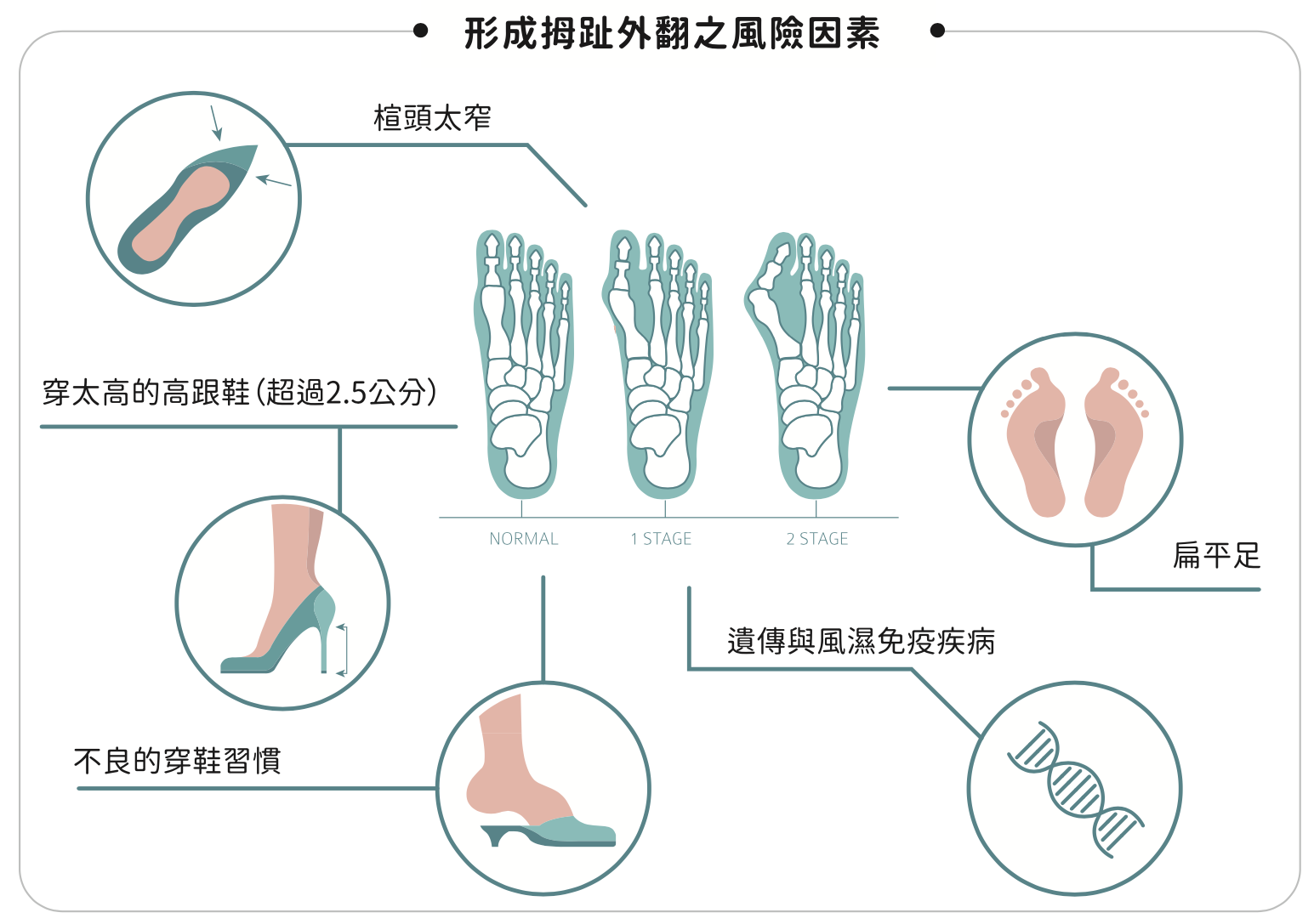拇指外翻診斷與預防︱陳建宏醫師
