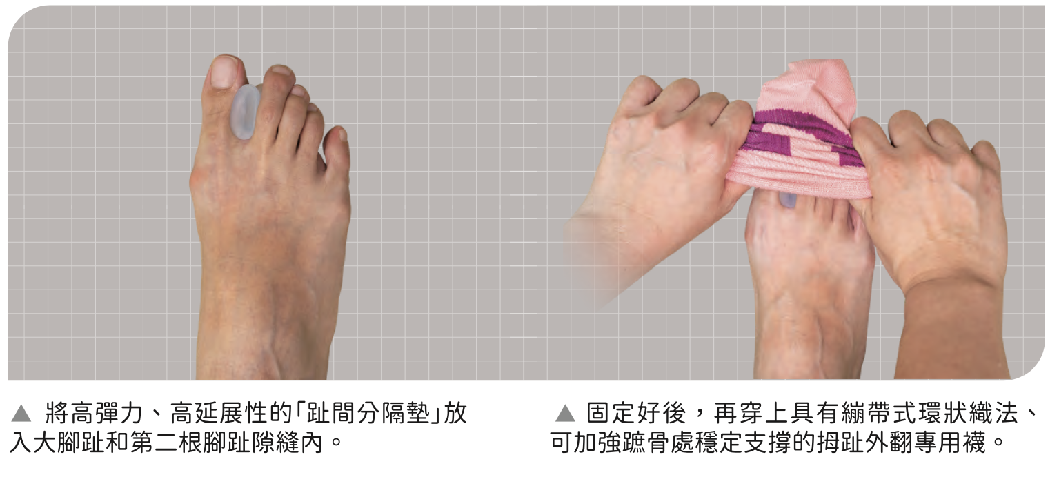 拇指外翻診斷與預防︱陳建宏醫師